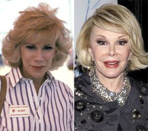 Celebrity-plastic-surgery-faces-before-after8