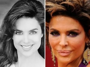lisa-rinna-plastic-surgery-before-after